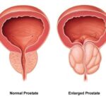 Enlarged Prostate